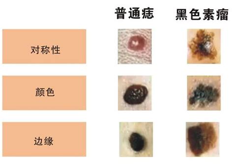 睪丸 黑痣|不大驚小怪！如何辨別「黑痣」與「黑色腫瘤」？ 